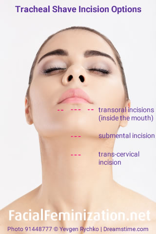 Tracheal Shave Incision Options